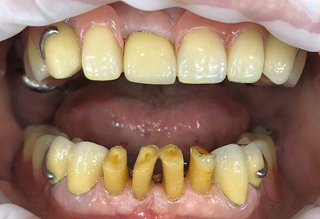 Восстановление частично отсутствующих зубов с помощью коронок и бюгельного протеза.
