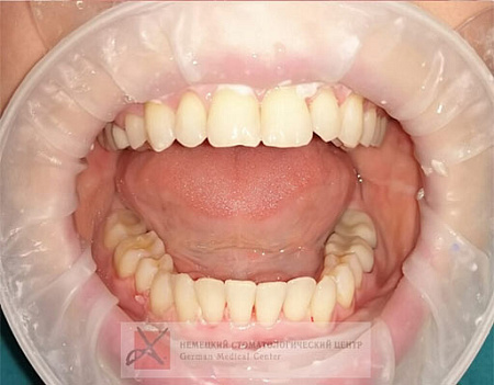 Отбеливание зубов системой Bleach'n Smile