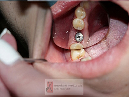 Разрушение зуба нижней челюсти справа ниже уровня десны