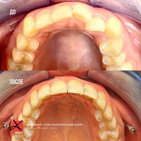 Комплексное гнатологическое и ортодонтичечкое лечение
