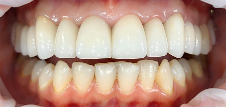 Протезирование на винирах и коронках, с целью эстетической коррекции зубов.