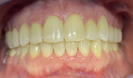 Ортодонтическое лечение элайнерами, протезирование и установка виниров